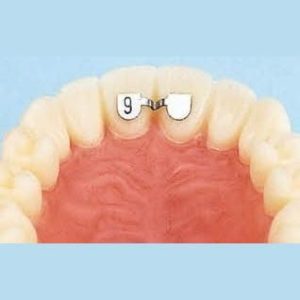 RETENEDORES CEMENTADO DIRECTO